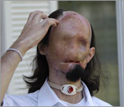 Picture of First Full Face Transplant in US (United States of America) Conducted to Dallas Wiens