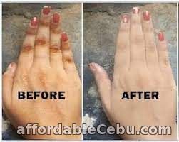 5th picture of Dark Knuckle Hand Elbow And Knee Brightening In Shizugawa, Miyagi Japan Call +2771 073 2372 Get Rid Scars Stretch Marks In Xaloztoc Mexico For Sale in Cebu, Philippines