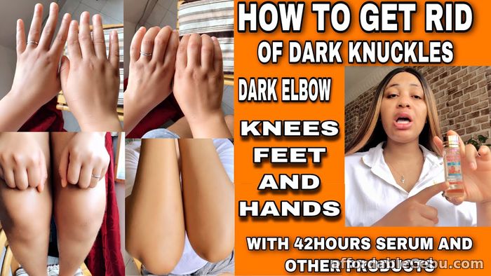 4th picture of Dark Knuckle Hand Elbow And Knee Brightening In Shizugawa, Miyagi Japan Call +2771 073 2372 Get Rid Scars Stretch Marks In Xaloztoc Mexico For Sale in Cebu, Philippines