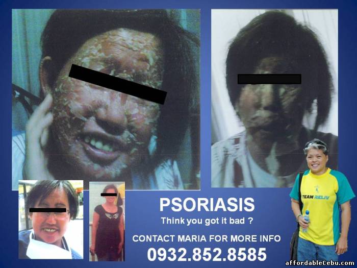 1st picture of PSORIASIS is NOT a Skin Problem For Sale in Cebu, Philippines