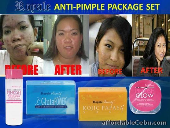 1st picture of Kojic Soap Say Bye Bye to Pimples For Sale in Cebu, Philippines