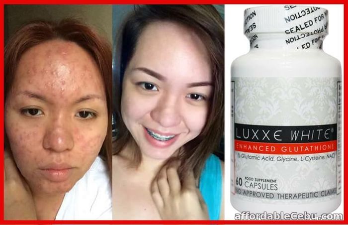 1st picture of Luxxe White Enhance Glutathione 60capsule in Cebu For Sale in Cebu, Philippines