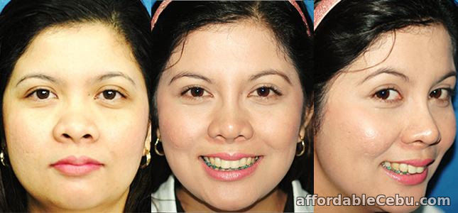 2nd picture of Rhinoplasty (Noselift) Philippines Offer in Cebu, Philippines