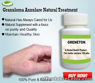 1st picture of Natural Treatment for Granuloma Annulare For Sale in Cebu, Philippines