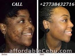 4th picture of BEST SKIN WHITENING AND BLEACHING PRODUCTS CALL +27738432716 For Sale in Cebu, Philippines