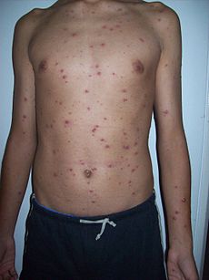 Picture of Hangga o Dati (Chickenpox)