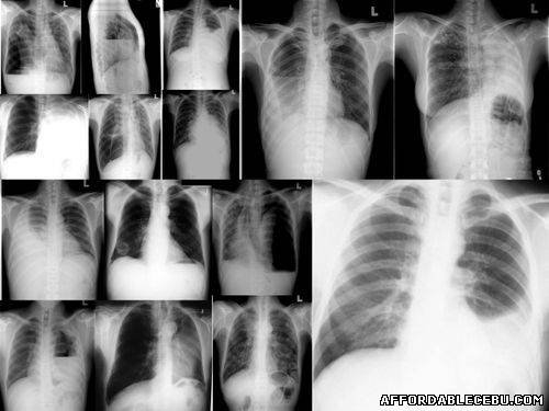 Picture of How to Avail of Diagnosis and Treatment of Pulmonary Tuberculosis (Sputum Smear Positive) in Cebu