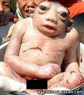 Picture of A Frog-Like Baby Born in Nepal