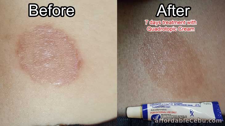 Before and After Quadrotopic Cream Treatment of Buni