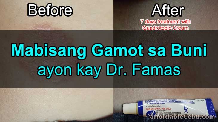 Mabisang Gamot sa Buni (Ringworm)